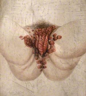 Female Genitalia Showing Severely Diseased Tissue Spreading onto the Thighs and Anus