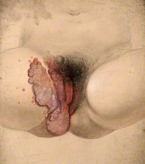 Female Genitalia Showing Severely Diseased Tissue Spreading onto the Right Inside Thigh
