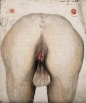 The Diseased Anus of a Man as Seen from Behind; Two Details of Sores on Other Parts of the Body