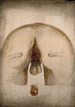 The Diseased Anus of a Man, as Seen from Behind, with Two Fingers on Each Buttock to Hold Them Apart; and a Detail of a Diseased Penis