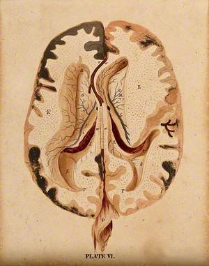 Brain: Horizontal Section Showing Lateral Ventricles