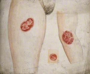 Sores and Diseased Skin on the Leg, Arm and Neck of a Woman