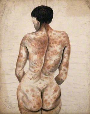 Back and Buttocks of a Woman Suffering from a Disease Affecting the Skin