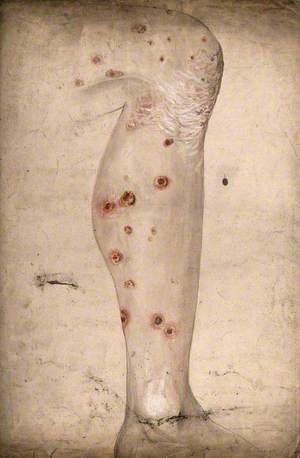 Diseased Skin and Sores on the Leg of a Man Suffering from Syphilis