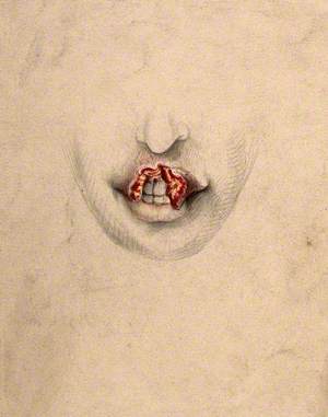 Severely Diseased Tissue on the Upper Lip of a Woman Suffering from Tertiary Syphilis