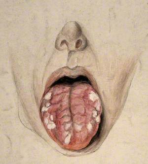 Diseased Tissue on the Tongue of a Man Suffering from Syphilis