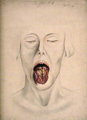 Diseased Tissue on the Tongue of a Woman Suffering from Syphilis