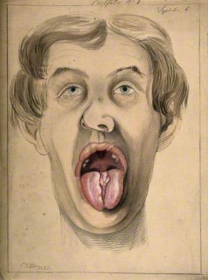 The Face of a Man Suffering from Syphilis, Shown with Mouth Open Wide, Displaying Areas of Diseased Tissue on the Tongue and Upper Lip