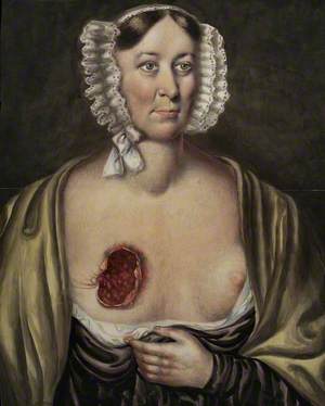 Mrs Prince, after Surgical Removal of a Breast