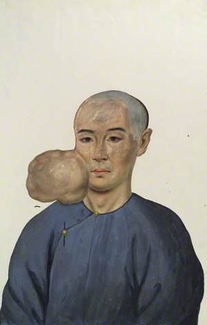 A Man (Chang Achum?), Facing Front, with a Tumour on the Right Side of His Face