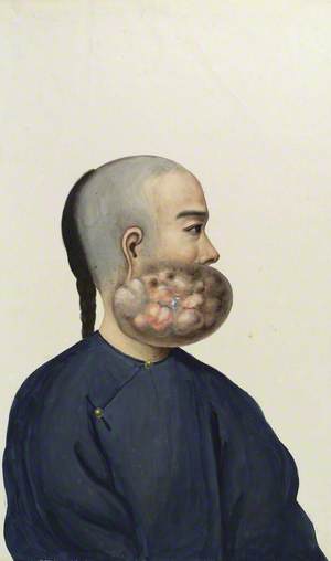 A Man (Leang Ashing), in Profile, with a Tumour on the Right Side of His Face