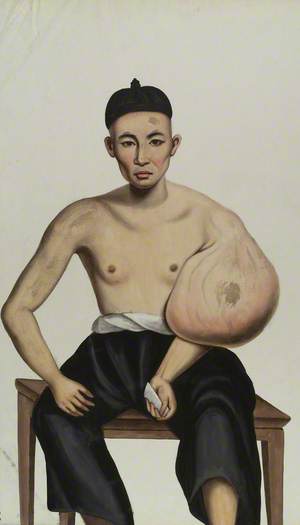A Man (Po Ashing) with a Tumour on His Left Arm