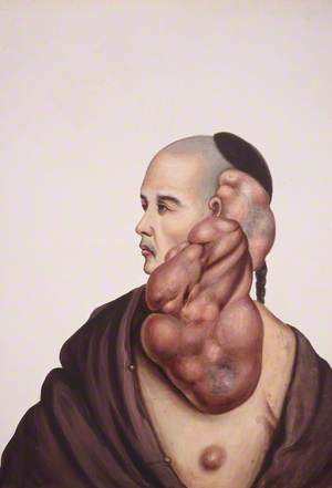 A Man (Wan Wakae) with Massive Pendent Tumours on the Left Side of His Face