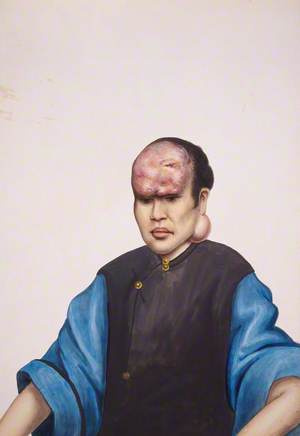 A Woman (Le Sanying) with Tumours on Her Forehead and under Her Left Ear