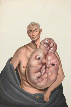 A Man (Woo Kinshing), Facing Front, with a Massive Tumour on the Left Side of His Trunk
