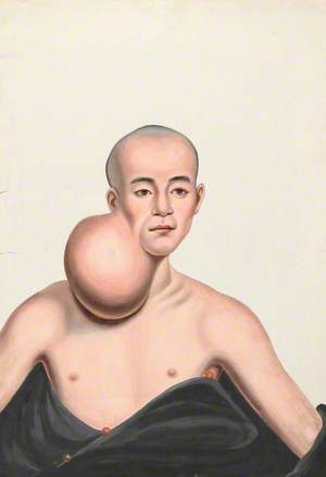 A Man (Choo Yihleang), Facing Front, with a Massive Spherical Tumour on the Right Side of His Neck