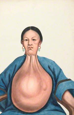 A Woman (Yang She), Facing Front, with a Massive Pendent Tumour Hanging Down from Her Neck