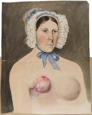 Mrs Broadbent, Afflicted with Breast Cancer