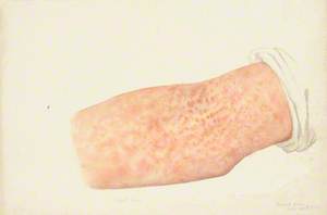 A Right Arm with Skin Disease Designated as Lichen Variegatus