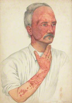 A Man with Disease Designated as Lupus Erythematosus