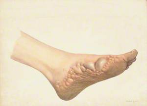 A Foot with Disease Designated as Pompholyx (Also Known as Eczema)