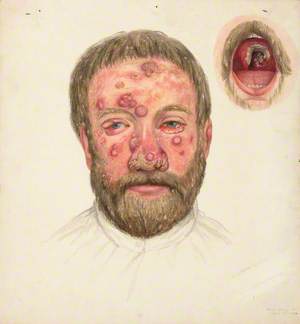 The Head of a Man with a Beard and Skin Disease