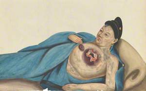 A Woman, Reclining, with a Large Tumour on Her Left Breast