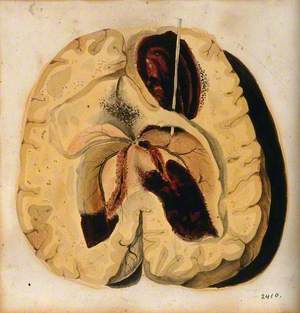 A Diseased Brain
