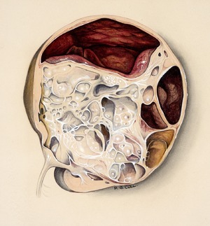 Dissected Kidney