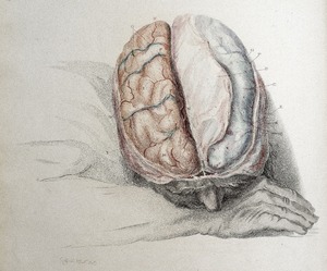 Dissected Brain