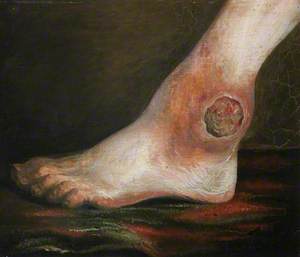 The Wounded following the Battle of Corunna: Gunshot Wound of Ankle Joint