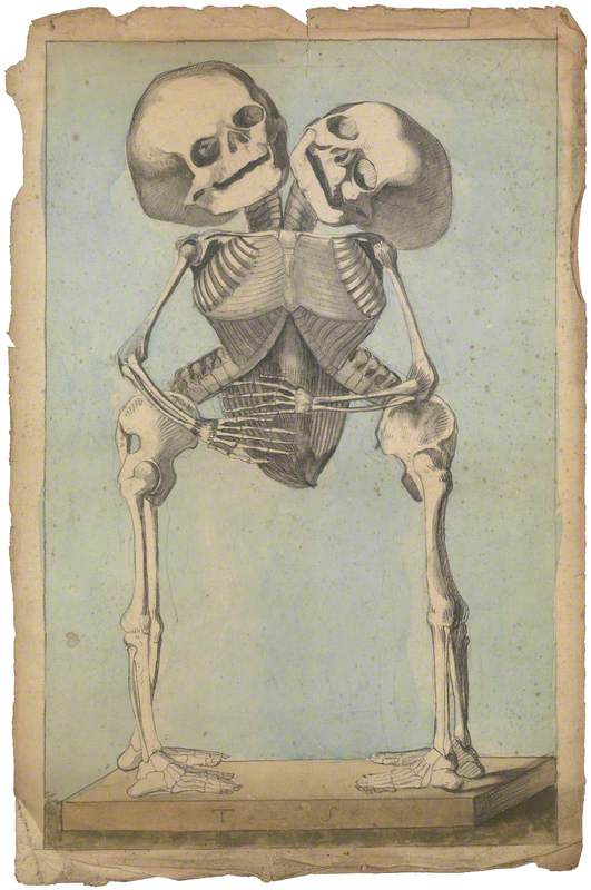 The Skeleton of Conjoined Twins Joined at the Thorax