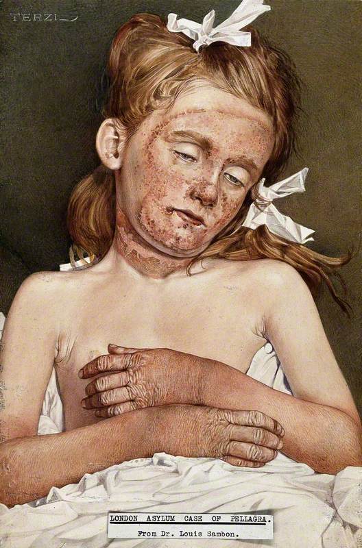 A Girl in the London Asylum Suffering from Chronic Pellagra