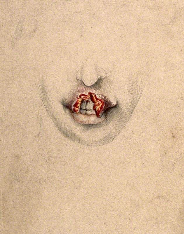 Severely Diseased Tissue on the Upper Lip of a Woman Suffering from Tertiary Syphilis