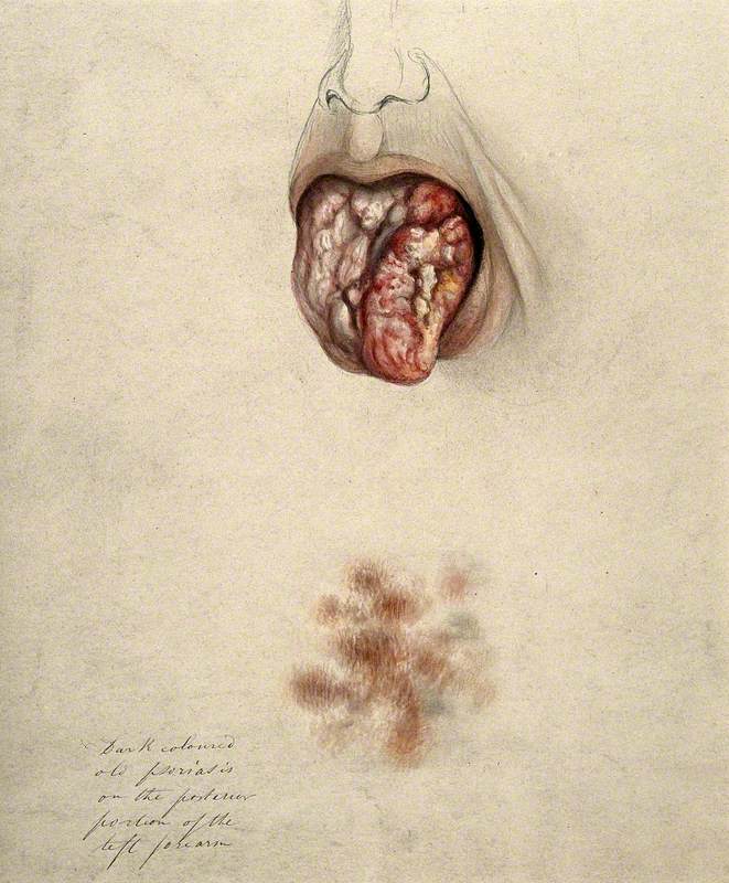 Diseased Tissue on the Tongue of a Man Suffering from Syphilis, with a Detail below Showing an Area of Psoriasis on the Man's Arm