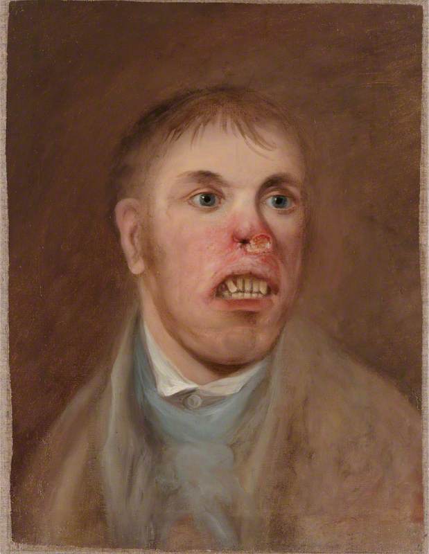 A Young Man, J. Kay, Afflicted with a Rodent Disease which Has Eaten Away Part of His Face