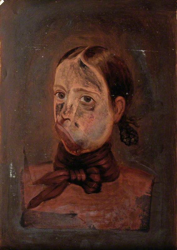 A Young Girl with a Deformed Mouth